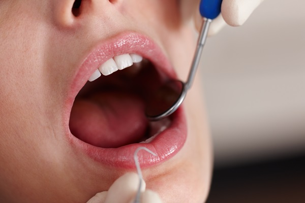 All About Getting A Dental Onlay